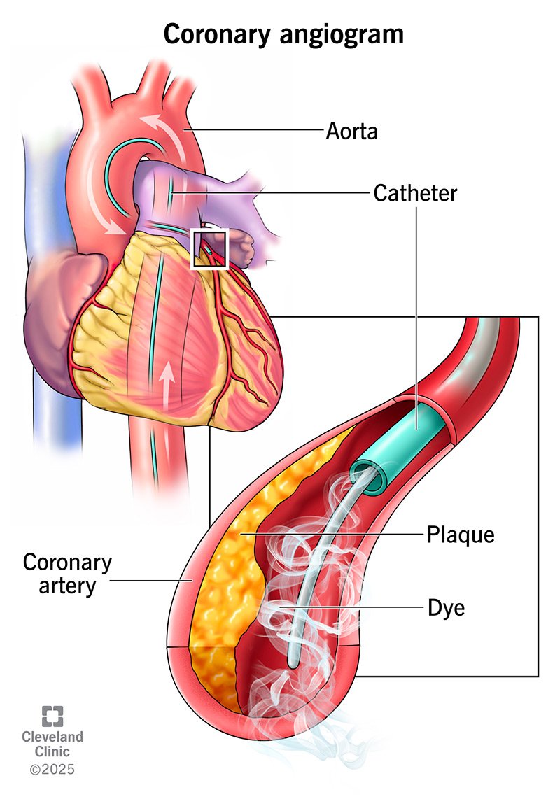Angiography